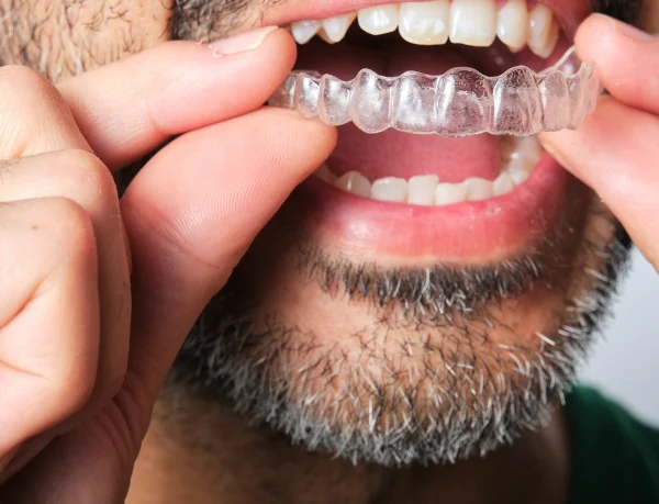 do-clear-aligners-work do-clear-aligners-work